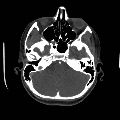 Cerebral venous sinus thrombosis (Radiopaedia 40619-43227 A 50).jpg