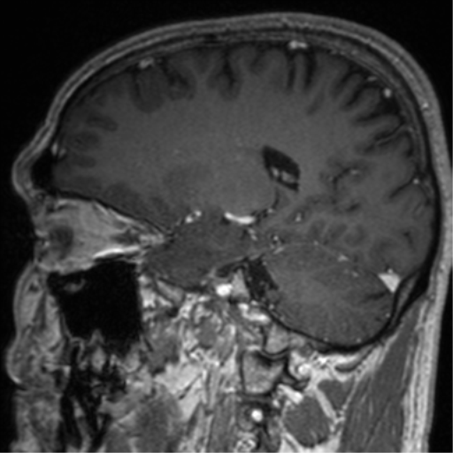 Cerebral venous thrombosis (Radiopaedia 38392-40469 Sagittal T1 C+ 56).png