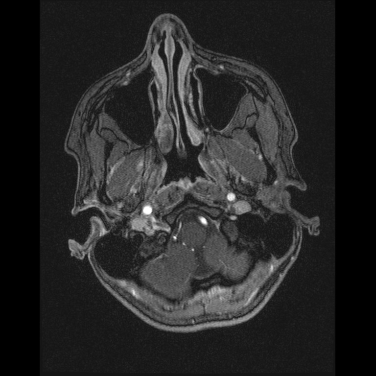 Cerebral venous thrombosis (Radiopaedia 45678-49854 Axial MRV 3).jpg