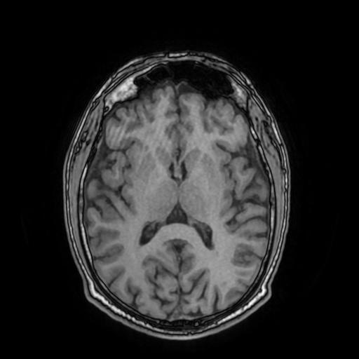 Cerebral venous thrombosis with secondary intracranial hypertension (Radiopaedia 89842-106957 Axial T1 99).jpg