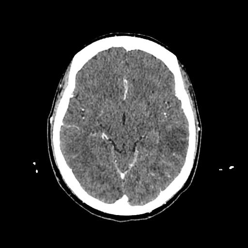 File:Cerebral venous thrombosis with venous hemorrhagic infarct (Radiopaedia 90354-107660 Axial with contrast 74).jpg
