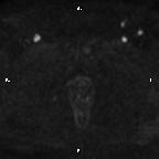 Cervical adenocarcinoma (Radiopaedia 65011-73985 Axial DWI 14).jpg
