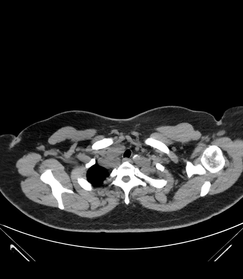 Cervical aortic arch with coarctation and aneurysms (Radiopaedia 44035-47552 Axial non-contrast 10).jpg