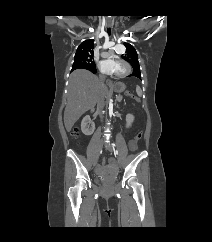 Cervical aortic arch with coarctation and aneurysms (Radiopaedia 44035-47552 C 24).jpg