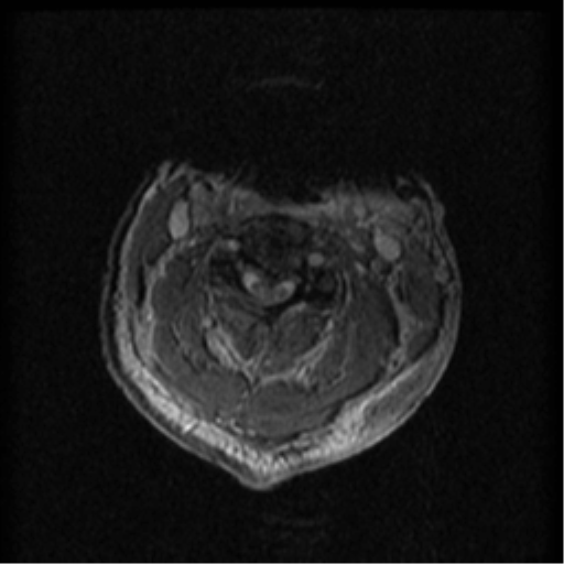 Cervical canal stenosis with cord compression (Radiopaedia 34114-35374 Axial Gradient Echo 61).png