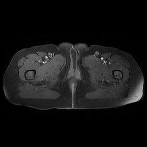 File:Cervical carcinoma (Radiopaedia 67644-77047 Axial T1 C+ fat sat 22).jpg