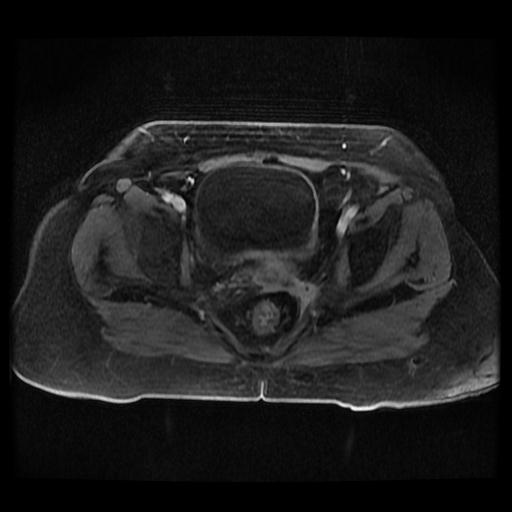 Cervical carcinoma (Radiopaedia 70924-81132 Axial T1 C+ fat sat 225).jpg