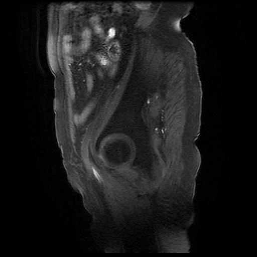 File:Cervical carcinoma (Radiopaedia 78847-91705 Sagittal T1 fat sat 1).jpg