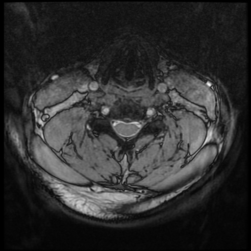Cervical disc extrusion (Radiopaedia 59074-66364 G 49).jpg