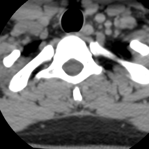 Cervical schwannoma (Radiopaedia 57979-64974 Axial non-contrast 59).png