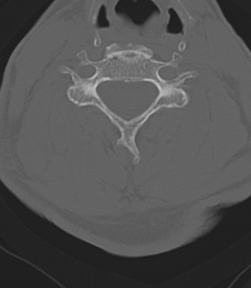 Cervical spine fractures with vertebral artery dissection (Radiopaedia 53296-59268 Axial bone window 32).png