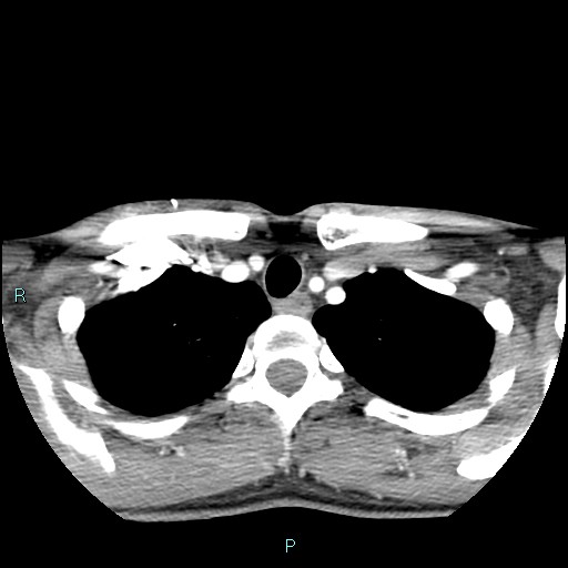 Cervical thymic cyst (Radiopaedia 88632-105335 B 23).jpg