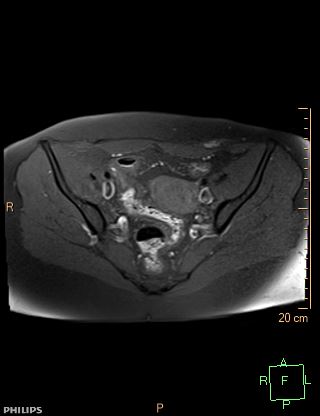 File:Cesarian scar endometriosis (Radiopaedia 68495-78066 Axial T1 fat sat 9).jpg