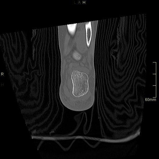 Chaput tubercle fracture (Radiopaedia 80319-93956 Coronal non-contrast 51).jpg