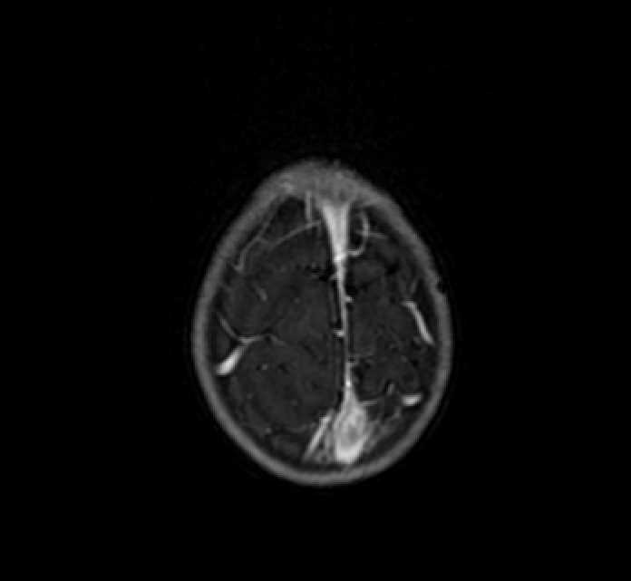Chiasmatic-hypothalamic glioma (Radiopaedia 90079-107252 Axial T1 C+ 84).jpg