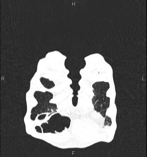 Chilaiditi sign (Radiopaedia 88839-105611 Coronal lung window 4).jpg