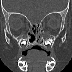Choanal atresia (Radiopaedia 88525-105975 Coronal bone window 43).jpg