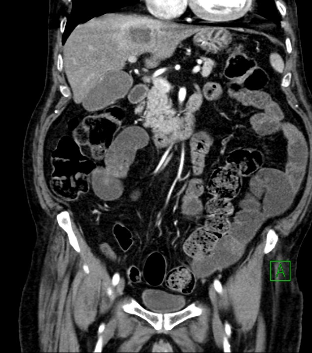 Cholangiocarcinoma with cerebral metastases (Radiopaedia 83519-98629 E 40).jpg