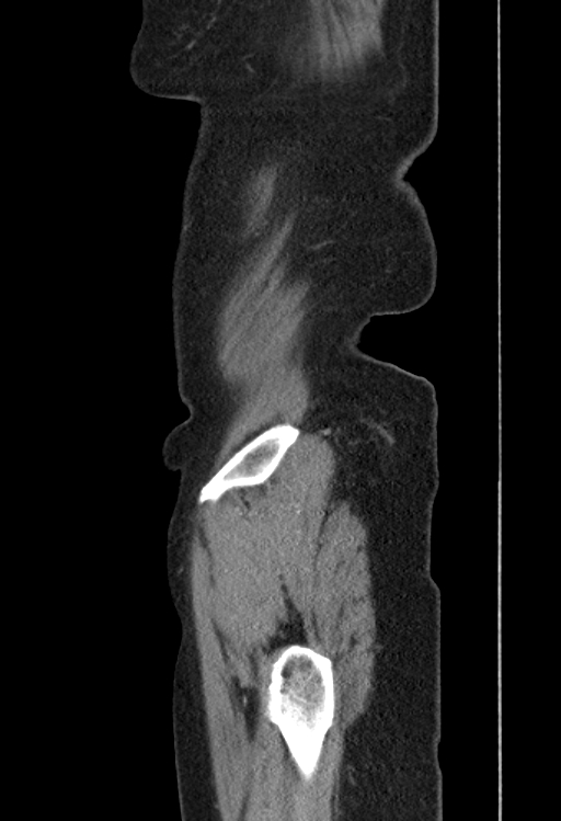 Cholecystoduodenal fistula due to calculous cholecystitis with gallstone migration (Radiopaedia 86875-103077 F 58).jpg