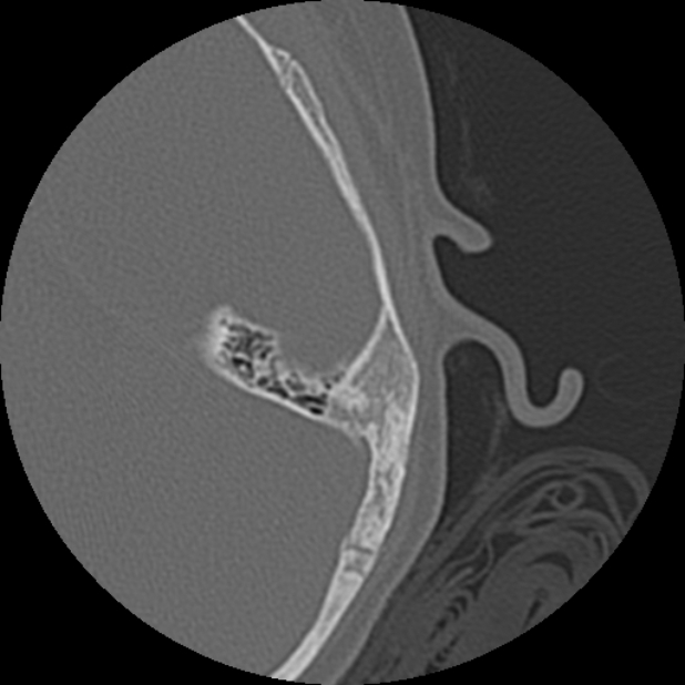 Cholesteatoma (Radiopaedia 73023-83750 Axial Left ear 75).jpg