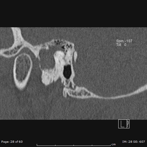 Cholesteatoma - external auditory canal (Radiopaedia 88452-105096 Sagittal bone window 28).jpg