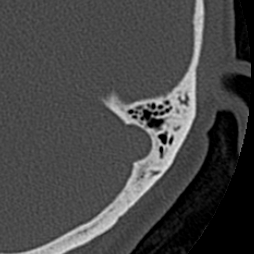 File:Cholesteatoma of the external ear (Radiopaedia 16540-16225 Axial bone window 6).jpg