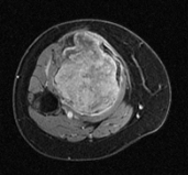 File:Chondromyxoid fibroma (Radiopaedia 10132-10672 Axial T1 C+ fat sat 1).jpg