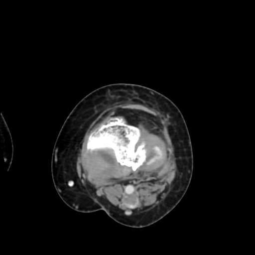 Chondrosarcoma - femur (Radiopaedia 64187-72954 Axial with contrast 58).jpg