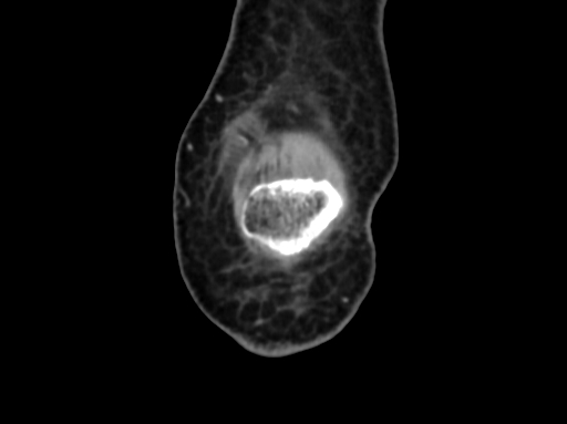 Chondrosarcoma - femur (Radiopaedia 64187-72954 C 5).jpg