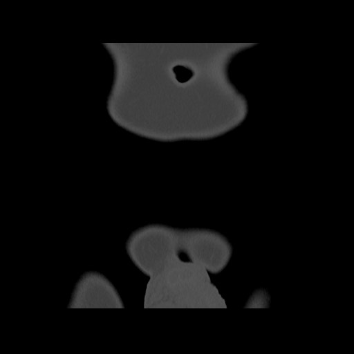 Chondrosarcoma of iliac wing (Radiopaedia 63861-72599 Coronal bone window 13).jpg