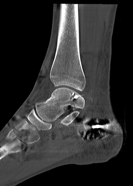Chopart fracture (Radiopaedia 35347-36861 Sagittal bone window 39).jpg