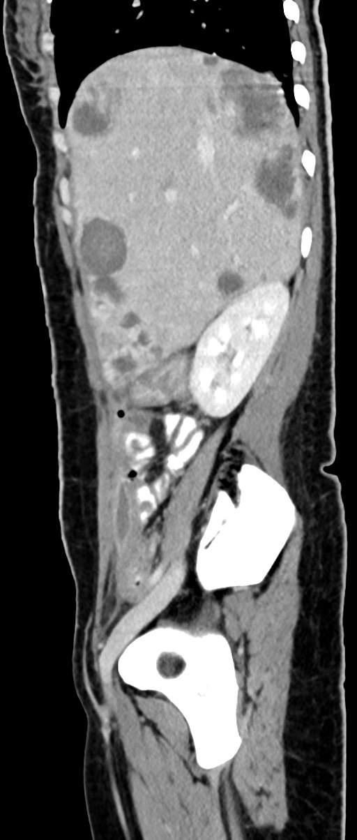 Choriocarcinoma liver metastases (Radiopaedia 74768-85766 C 126).jpg