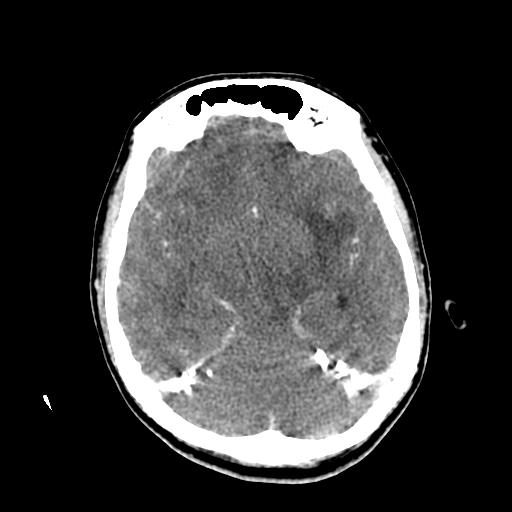 File:Choriocarcinoma of ovary with cerebral and pulmonary metastases (Radiopaedia 25983-26118 C+ arterial phase 66).jpg
