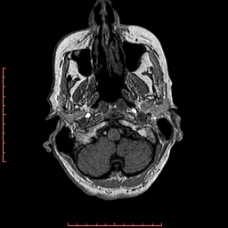Choroid plexus xanthogranuloma (Radiopaedia 67843-77270 Axial T1 144).jpg