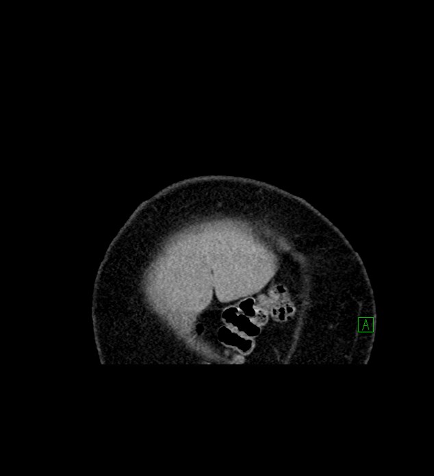 Chromophobe renal cell carcinoma (Radiopaedia 84239-99519 C 4).jpg