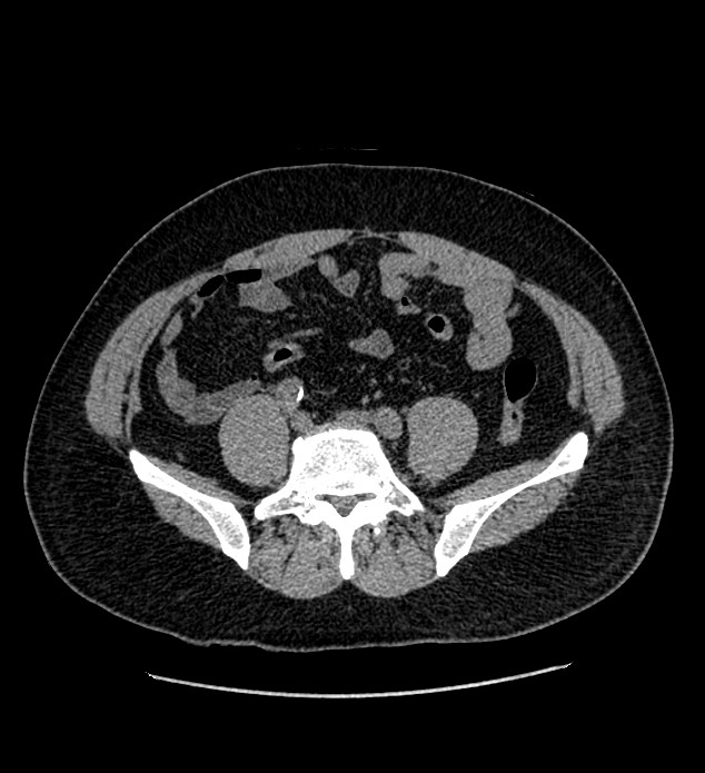 Chromophobe renal cell carcinoma (Radiopaedia 84337-99693 Axial non-contrast 106).jpg