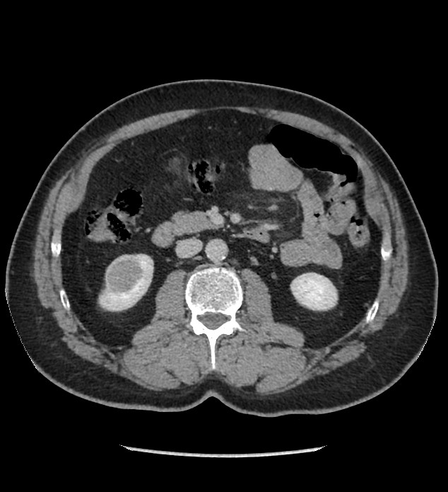 Chromophobe renal cell carcinoma (Radiopaedia 86879-103083 C 67).jpg
