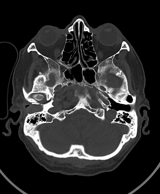 Chronic bilateral subdural hygroma (Radiopaedia 85801-101623 Axial bone window 98).jpg