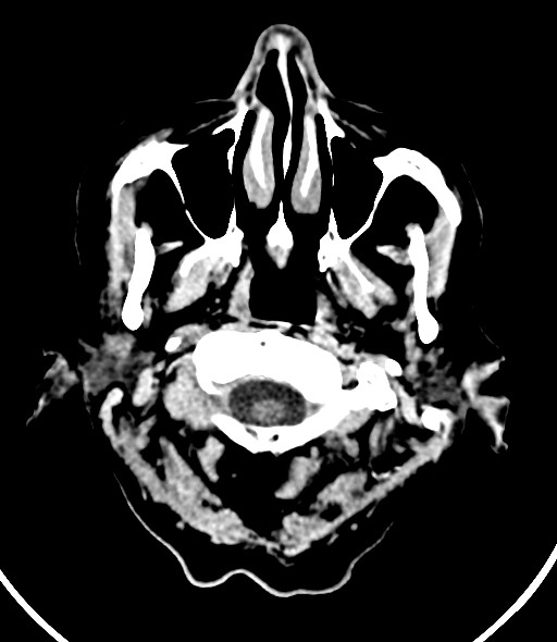 Chronic bilateral subdural hygroma (Radiopaedia 85801-101623 Axial non-contrast 59).jpg