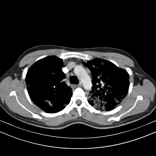 Chronic eosinophilic pneumonia (Radiopaedia 39331-41587 Axial C+ delayed 40).png
