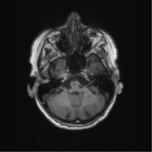 Chronic hypertensive encephalopathy (Radiopaedia 72844-83495 Axial T1 57).png