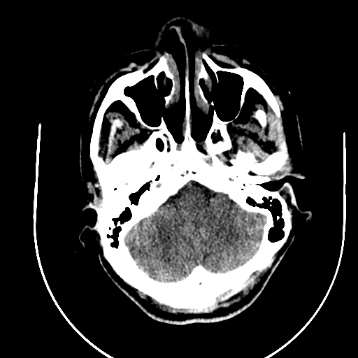 Chronic invasive fungal sinusitis (Radiopaedia 91563-109286 Axial non-contrast 12).jpg