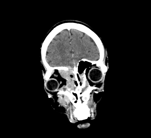 Chronic invasive fungal sinusitis with intraorbital and intracranial extension (Radiopaedia 56387-63046 C 77).jpg