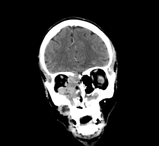 Chronic invasive fungal sinusitis with intraorbital and intracranial extension (Radiopaedia 56387-63046 C 98).jpg