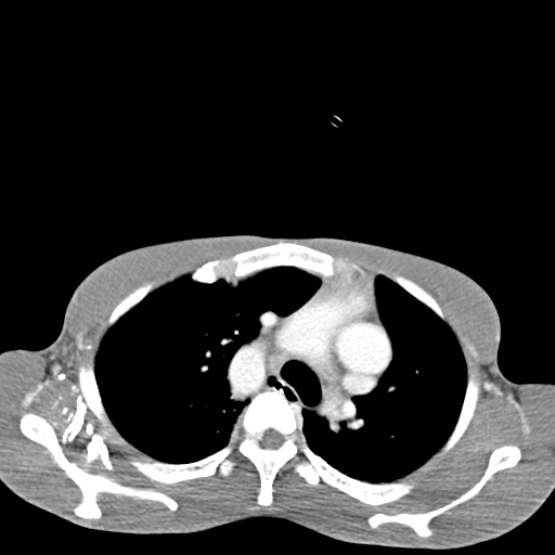 Chronic large bowel pseudo-obstruction (Radiopaedia 43181-46492 A 1).jpg