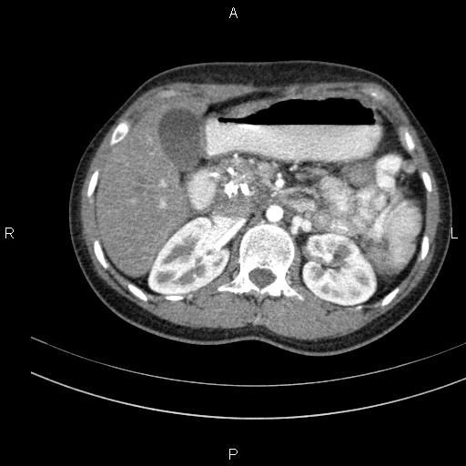 File:Chronic pancreatitis (Radiopaedia 64576-73450 B 53).jpg