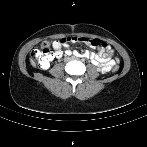 Chronic pancreatitis (Radiopaedia 64576-73450 C 103).jpg