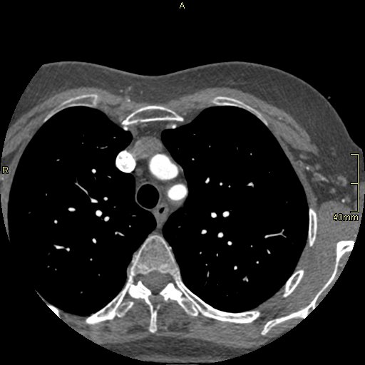 Chronic pulmonary embolism (Radiopaedia 73073-85094 Axial C+ CTPA 8).jpg
