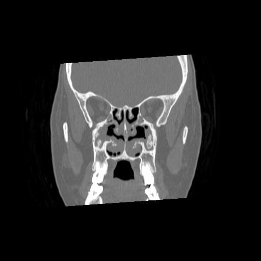 File:Chronic sinusitis with intra-sinus calcification (Radiopaedia 63919-72668 Coronal bone window 14).jpg