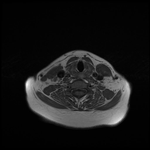 File:Chronic submandibular sialadenitis (Radiopaedia 61852-69885 Axial T1 22).jpg